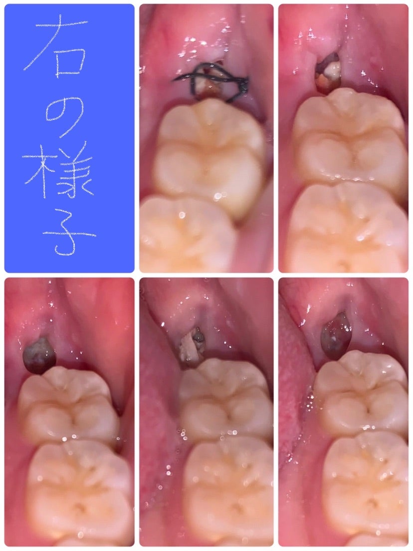 親知らず 抜い た 後 白い