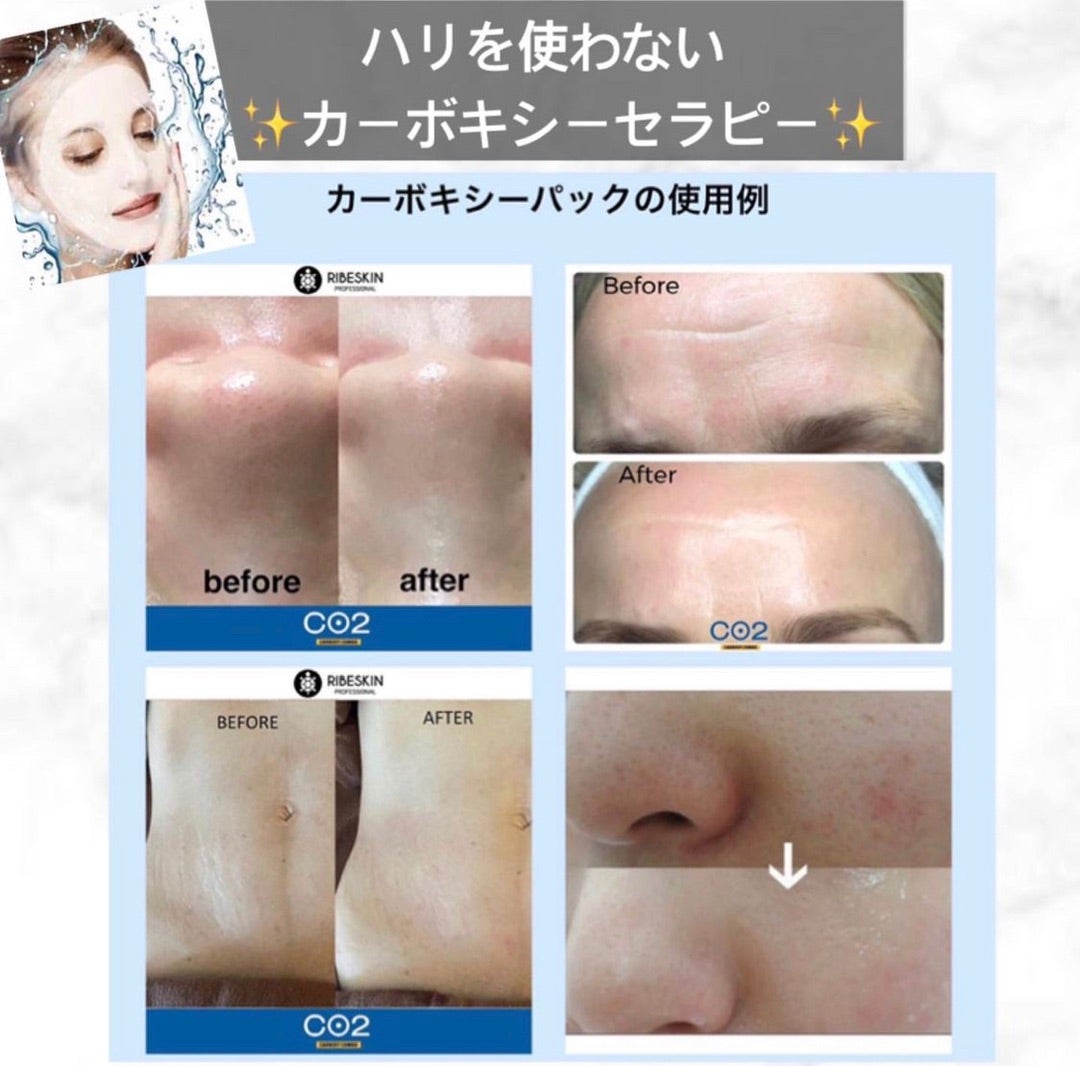 韓国製薬会社発祥☆カーボキシー高濃度炭酸ガスパック | 美肌育成
