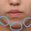 顎の長期作用型ヒアルロン酸注射の症例☆☆☆の画像