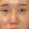 L型プロテーゼにより鼻尖の皮膚が薄くなったケース：異物摘出術と真皮脂肪移植の画像