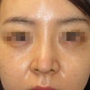 修正術：鼻中隔延長部の減量およびシリコンプロテーゼ摘出の画像