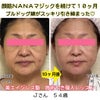 ブルドッグ顔、マリオネットライン、顔のたるみを改善する特許取得した表情筋トレーニングＪさん５４歳の画像