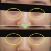 目の下のクマ治療・マイクロCRF・20代女性・BMI 19の画像