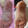 インディバで母の足がこんなに綺麗になりました！(#^.^#)の画像
