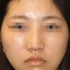 鼻中隔延長術　目立った鼻の修正：鼻中隔部メッシュ全摘と耳甲介軟骨による鼻中隔部補強の画像