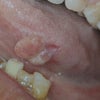 「舌癌」の特徴の画像