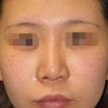 鼻中隔軟骨採取による鼻中隔延長術で鼻尖が低くなったケース：肋軟骨による2度目の鼻中隔延長術の画像