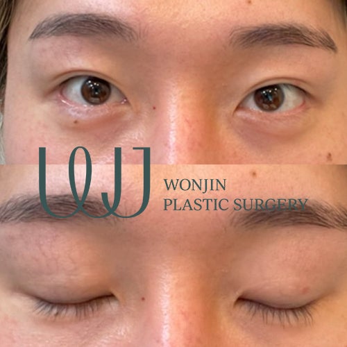 Wonjin Beauty Medical Group 整形ツアー 美容整形 韓国美容整形 目整形 鼻の手術 鼻の整形 目の手術 韓国の整形手術 韓国の整形 江南の整形外科 両顎手術 輪郭整形 顔のライン リフトアップ 若返り手術 韓国 美容整形 ツアー