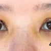 眼瞼下垂手術　術後4〜6日目　経過の画像
