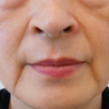 グロースファクターによるほうれい線治療　60代女性⑤の画像