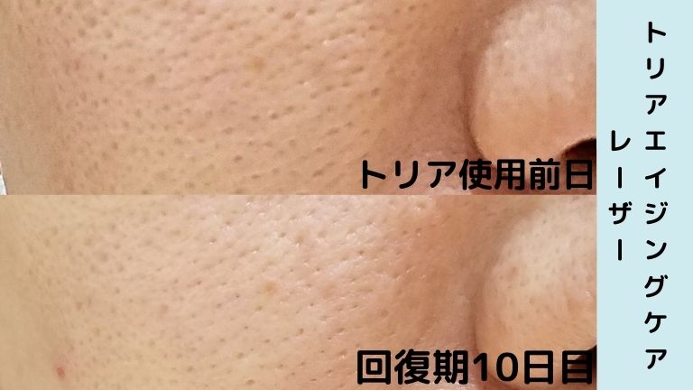 2022年はトリア美顔器をレベル1で1年使ってみたいと思います 2022年はトリア美顔器をレベル1で1年使ってみたいと思います