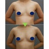 エクソソーム豊胸・アラサー女子・BMI 20の画像