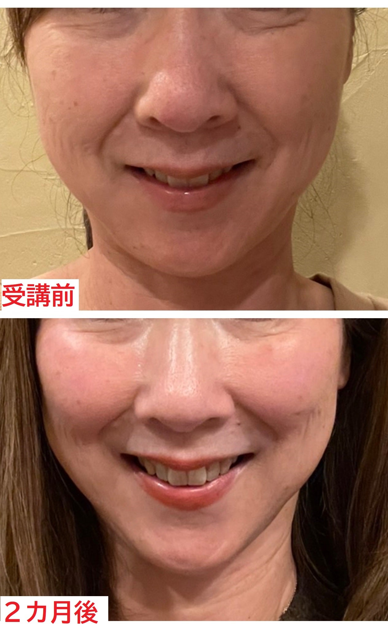 2カ月で頬が上がった!「講座に参加してよかった!」 | 美容整形 2カ月で頬が上がった!「講座に参加してよかった!」 | 美容整形