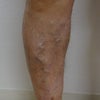 下肢静脈瘤　症例258の画像