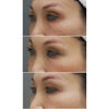 目の上の脂肪注入・マイクロCRF・40代女性・BMI 18の画像