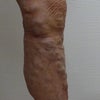 下肢静脈瘤　症例259の画像