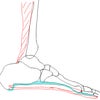 足底筋膜炎・足底腱膜炎の定義・原因の画像