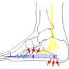足底筋膜炎の症状・診断の画像