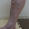 下肢静脈瘤　症例261　の画像