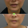 顎先の脂肪注入・CRF・50代女性・BMI 18の画像