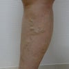 下肢静脈瘤　症例263の画像