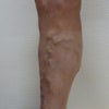 下肢静脈瘤　症例264の画像