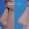 【症例】拘縮鼻の矯正手術の画像