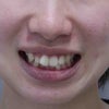 21歳　女性　上顎前突が主訴　小臼歯4本抜歯による治療が終了しました。の画像