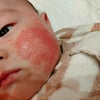 皮膚科でも小児科でも治らなかった赤ちゃんの肌荒れが改善！！の画像