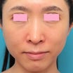 小鼻縮小と人中短縮を同時に行った30代女性の経過画像です。
