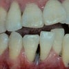 妊娠と「歯のぐらつき」の画像
