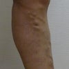 下肢静脈瘤　症例265の画像