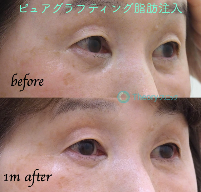 目の下の他院脱脂後 凹みの修正 右斜め   美容外科医 セオリー