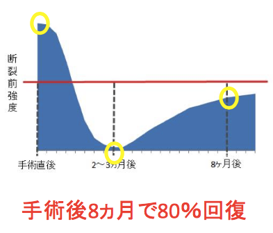 前十字靭帯再建 再断裂に関わる事 再建靭帯はいつ成熟するのか 40代 Men S育児の徒然日記 前十字靱帯断裂再建手術の記録 前十字靭帯再建 再断裂に関わる事 再建靭帯はいつ成熟するのか 40代 Men S育児の徒然日記 前十字靱帯断裂再建手術の記録