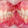 【症例写真】八重歯、ガミースマイル矯正の画像