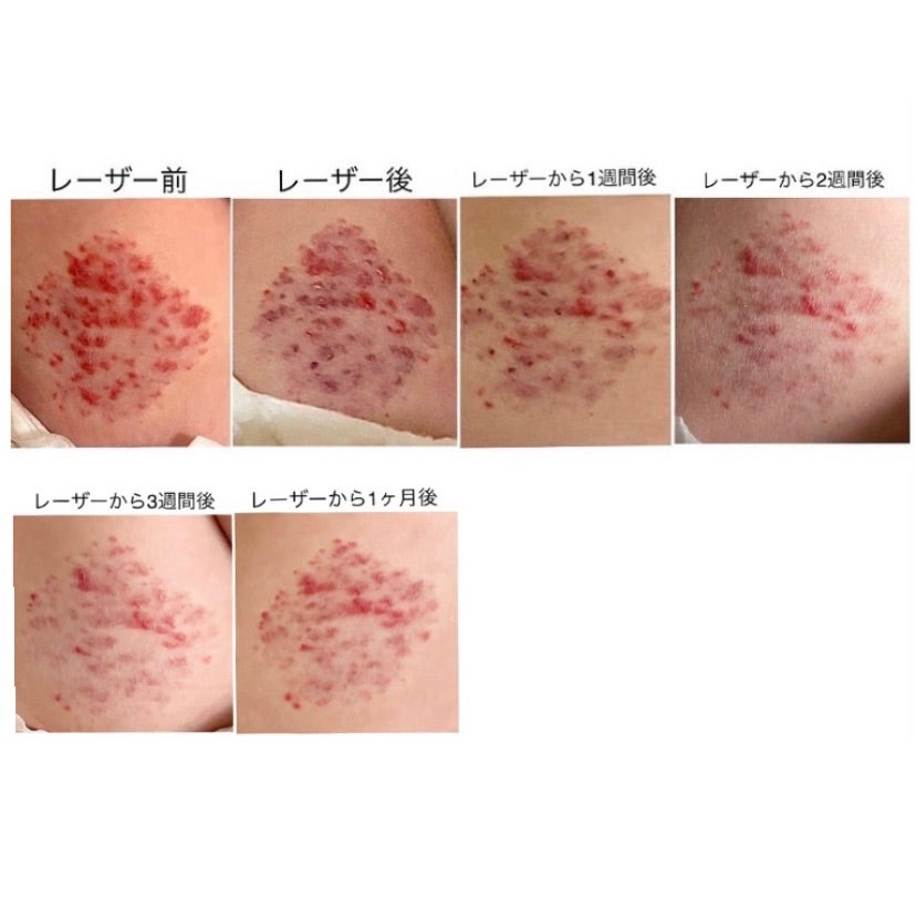 いちご状血管腫9.一ヶ月後 | mochi-neko17のブログ