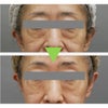 目の下のたるみ治療・『目の下』と『頬』の脂肪注入・50代女性・BMI 17の画像