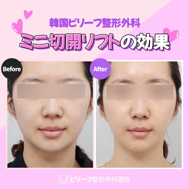 韓国ビリーフ整形外科　フェイスリフト　リフトアップ　切開リフト 糸リフト　顔のたるみ　ミニ切開リフト　ミニリフト