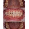 舌側矯正の術前術後の画像