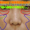 ★348　39歳女性　経結膜脱脂術+マイクロCRF　（目の下・中顔面）クマ治療