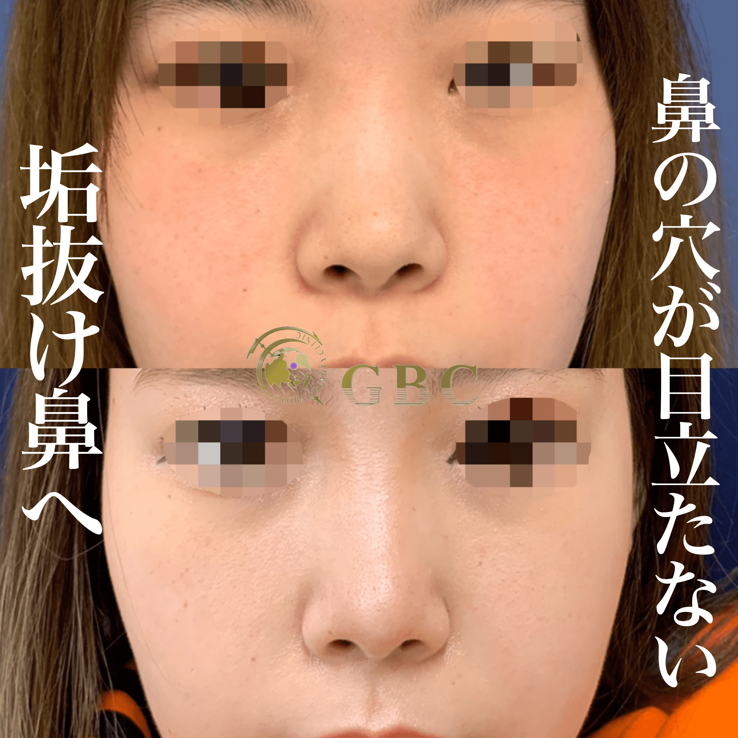 鼻の穴が目立たない！垢抜け鼻へ | グローバルビューティー