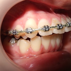 他院における非抜歯拡大治療から抜歯治療に切り替えた症例の治療が終了しました。の画像