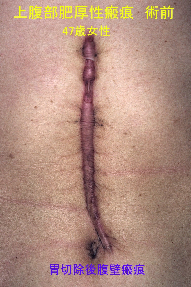 傷跡の形成手術～体幹部瘢痕拘縮～ | 美容外科と形成外科で40年～盛岡 