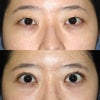 瞼板アンカー法を用いた上眼瞼形成(二重形成)手術の画像