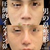 【男の鼻整形】圧倒的イケメン鼻の画像