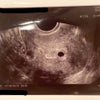 胎嚢確認。BT19/5w3dの画像