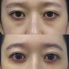 拡大経結膜下瞼形成手術後、1年9ヶ月の画像