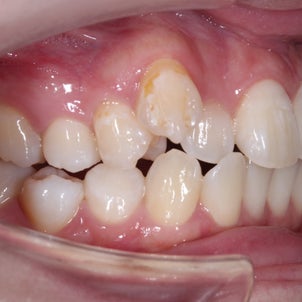 23歳　女性　八重歯が主訴　上顎犬歯2本抜歯、下顎小臼歯2本抜歯の治療が終了しました。の画像