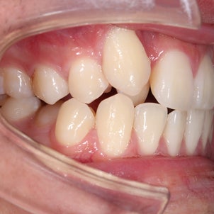 20歳　男性　八重歯が主訴　小臼歯４本抜歯による治療が終了しました。の画像