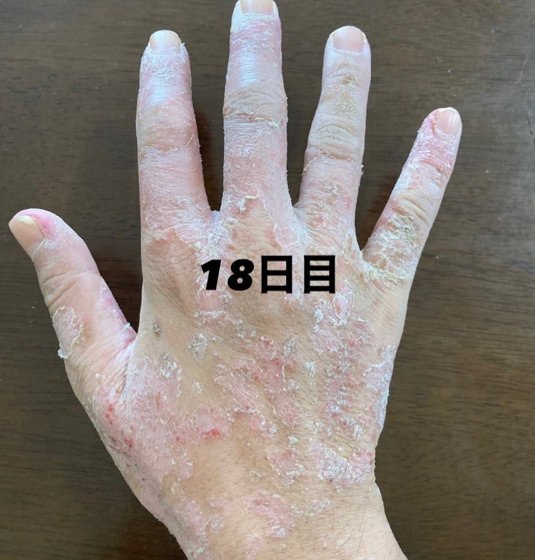 楽天ブックス: アトピ-性皮膚炎はこわくない - アトピ-が治ら